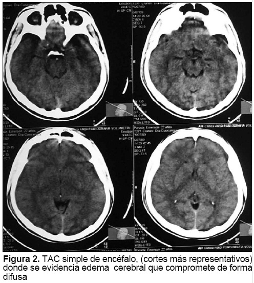 Que Es Edema Cerebral Agudo Que Es Edema Cerebral Agudo