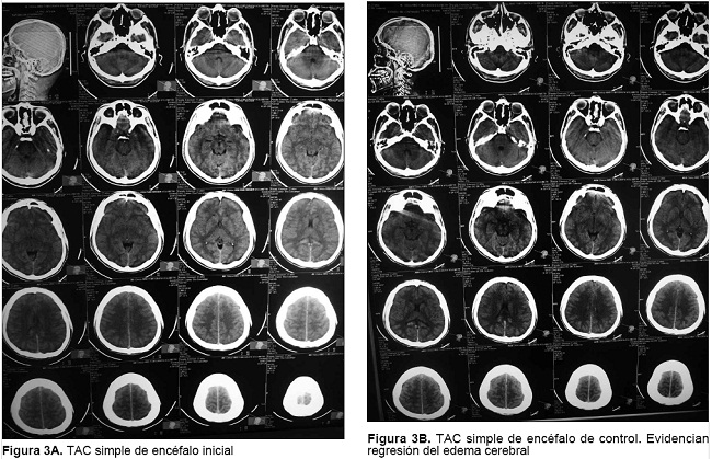 Que Es Edema Cerebral Agudo Que Es Edema Cerebral Agudo