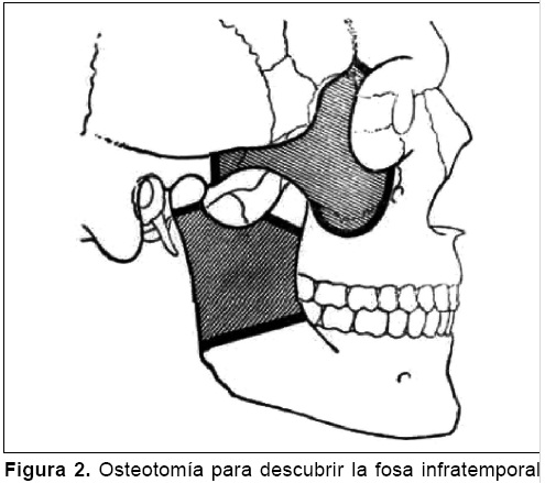 Músculo Esfenomandibular, Quinto Masticador