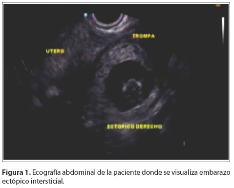 Embarazo ectopico online da positivo