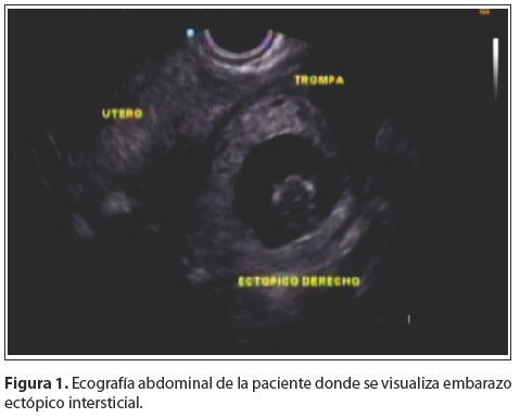 Signos De Amenaza De Aborto En El Primer Trimestre