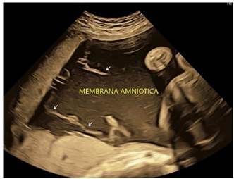 Diagnóstico y manejo de sindrome de brida amniótica