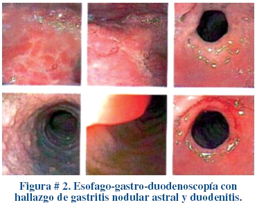 Fisiopatologia Ulcera Varicosa Pdf