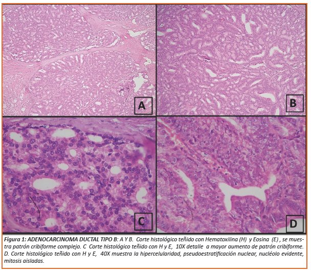 adenocarcinoma acinar prostata