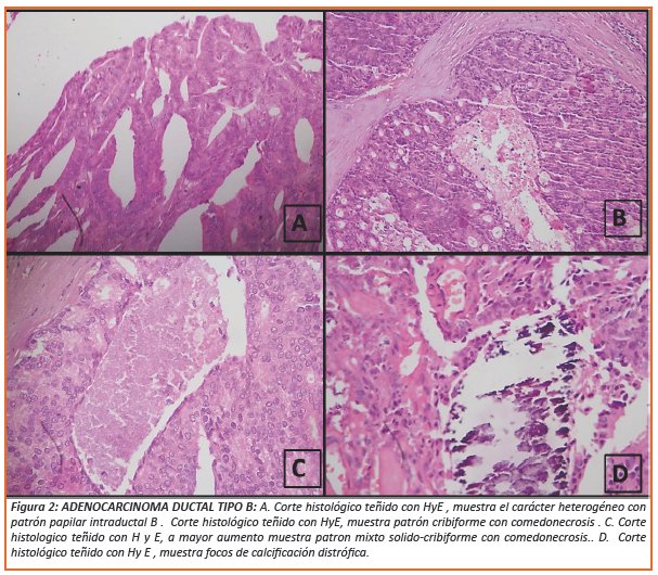 cáncer de próstata histología pdf)