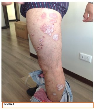 psoriasis vulgar pdf ha a test viszket és vörös foltok borítják