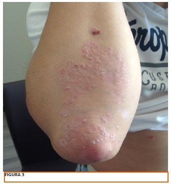 psoriasis vulgar pdf pikkelysömör kezelése népi gyógymódokkal láb