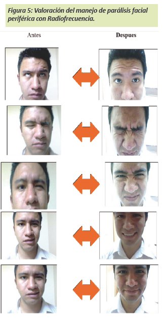 Masajes paralisis facial periferica deals