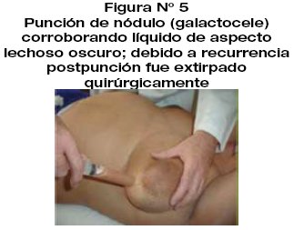 papiloma intraductal en el embarazo
