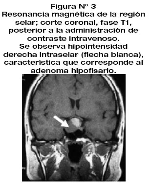 Microadenoma 4mm. A hipofízis adenoma kialakulása, tünetei és kezelése