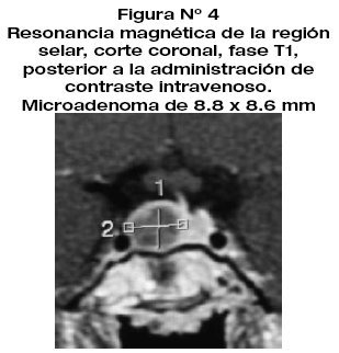 microadenoma de 4mm