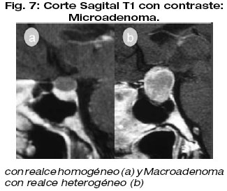 microadenoma de 4mm