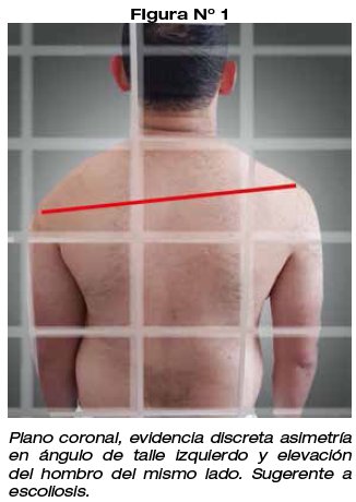 Nublado transacción Personal PREVALENCIA DE ALTERACIONES POSTURALES DE LA COLUMNA VERTEBRAL, ASOCIADA AL CARENTE HÁBITO DEPORTIVO, EN JÓVENES DE 17 A 22 AÑOS DE EDAD DE ABRIL- JUNIO DEL 2017 Nublado transacción Personal PREVALENCIA DE ALTERACIONES POSTURALES DE LA COLUMNA VERTEBRAL, ASOCIADA AL CARENTE HÁBITO DEPORTIVO, EN JÓVENES DE 17 A 22 AÑOS DE EDAD DE ABRIL- JUNIO DEL 2017